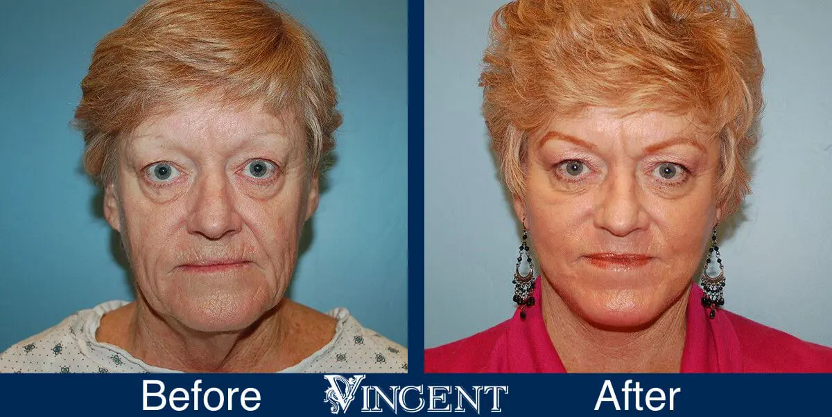 facelift-before-and-after-salt-lake-city-utah-1016_Lower_face_and_neck-lift_C02_perioral_frontview-1