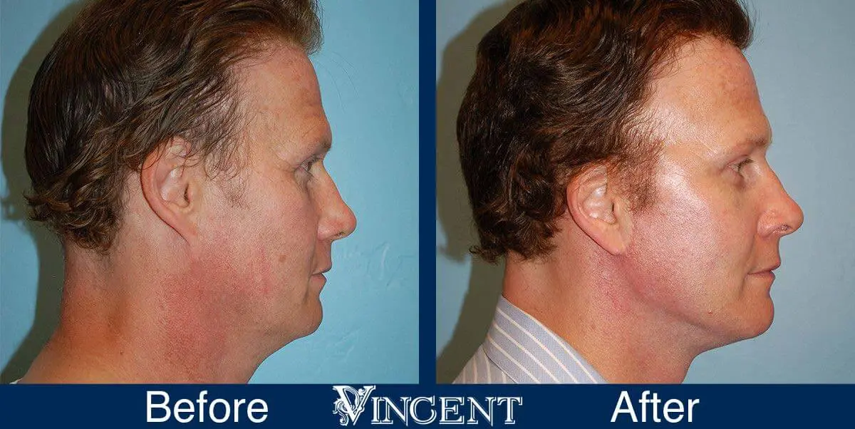 facelift-before-and-after-salt-lake-city-utah-1018_SwiftLift_w_extension_sideview