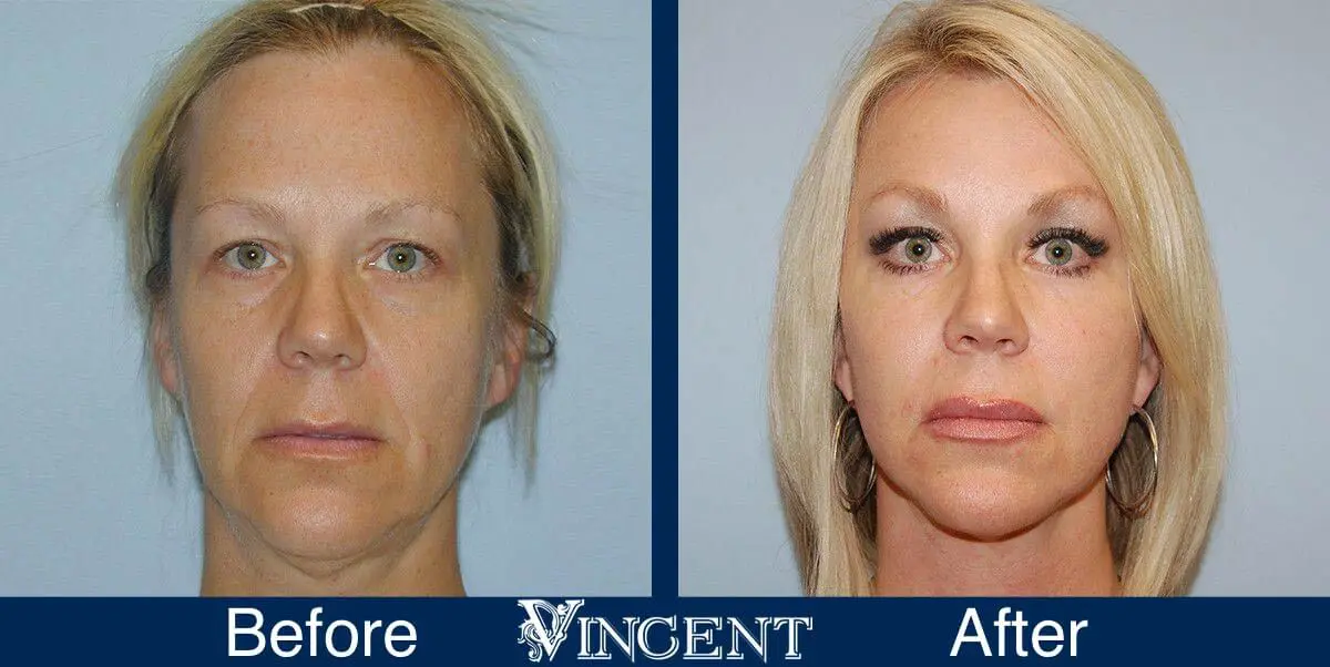 facelift-before-and-after-salt-lake-city-utah-1019_SwiftLift_upper_and_lowerblephs_fat-grafting_BBA430cc_Mastopexy_fron