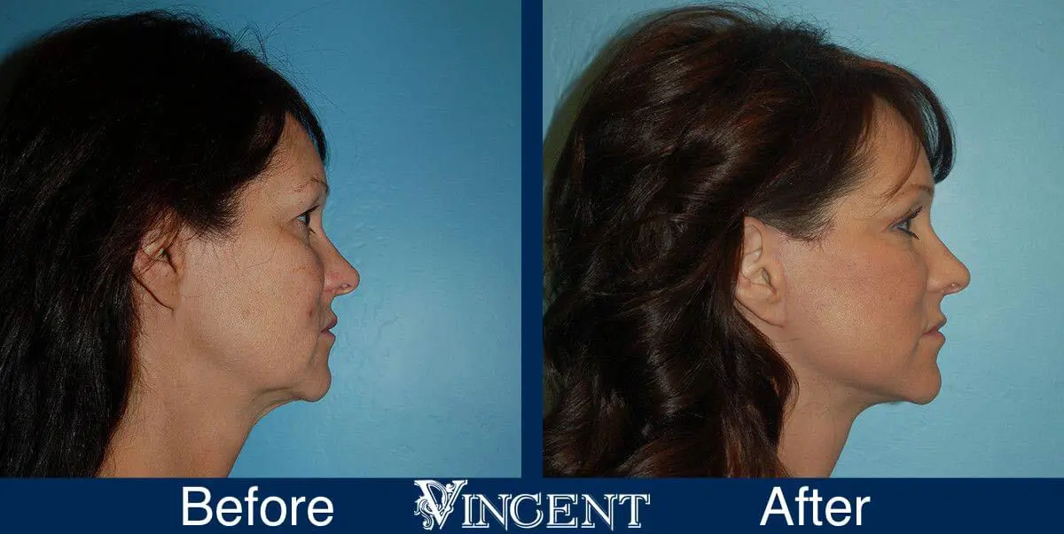 facelift-before-and-after-salt-lake-city-utah-1021_SwiftLift_w_extension_side