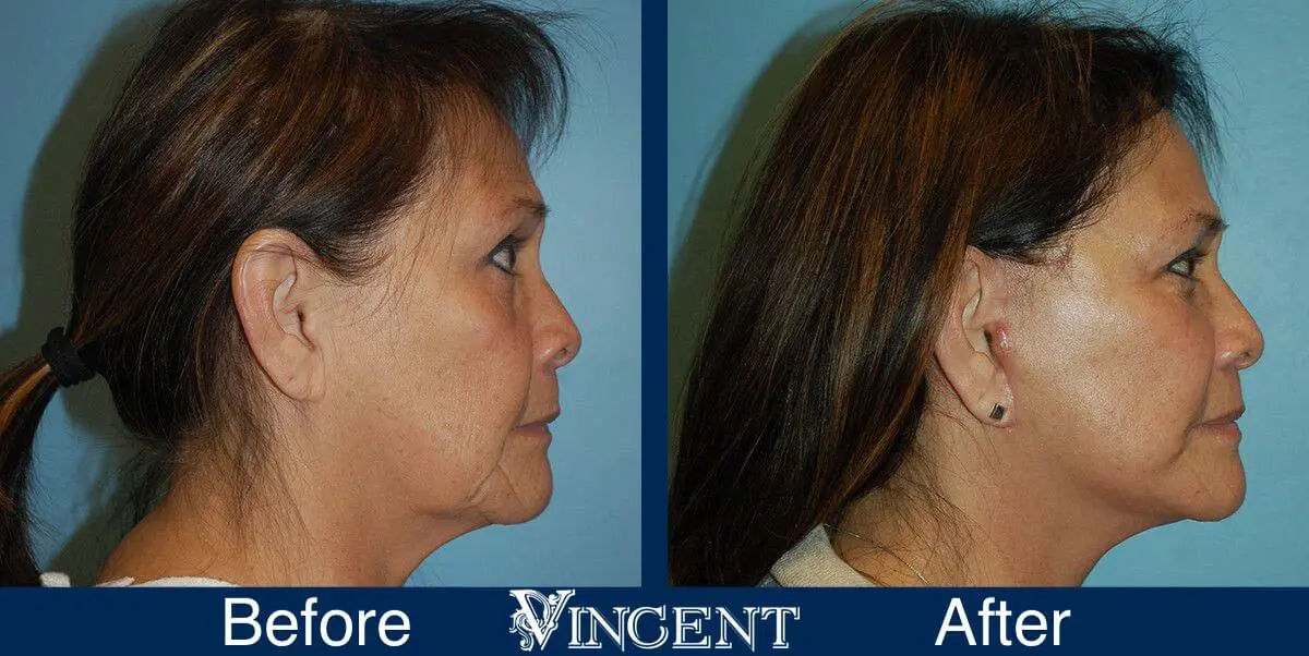 facelift-before-and-after-salt-lake-city-utah-1026_SwiftLift_w_extension_Drake_Vincent_sideview