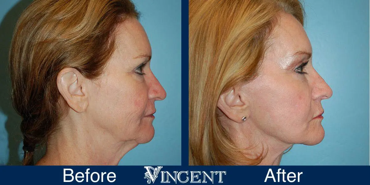 facelift-before-and-after-salt-lake-city-utah-1027_SwiftLift_w_Browlift_Drake_Vincent_sideview