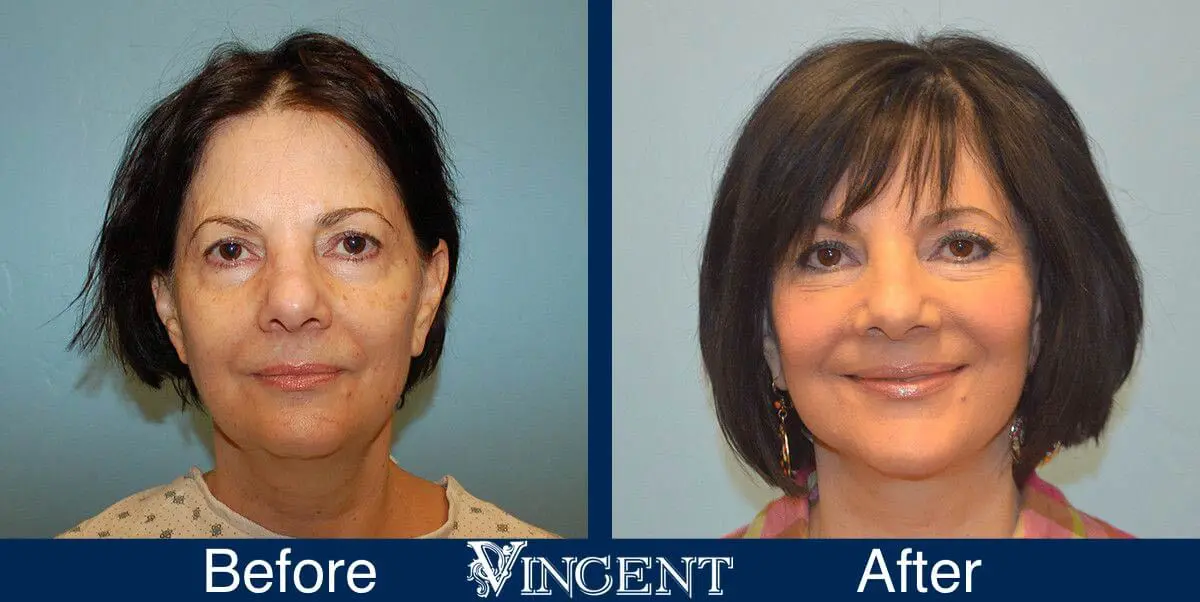 facelift-before-and-after-salt-lake-city-utah-1028_SwiftLift_w_Extension_Drake_Vincent_frontview