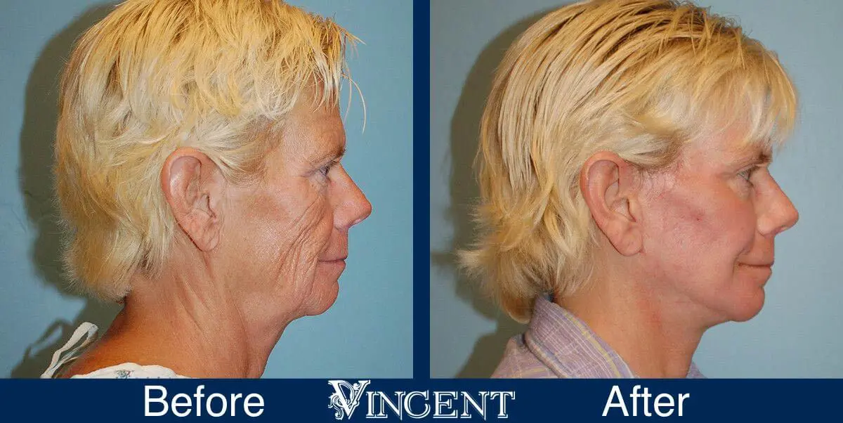 facelift-before-and-after-salt-lake-city-utah-1029_SwiftLift_CO2_full_face_fat_grafting_Drake_Vincent_sideview