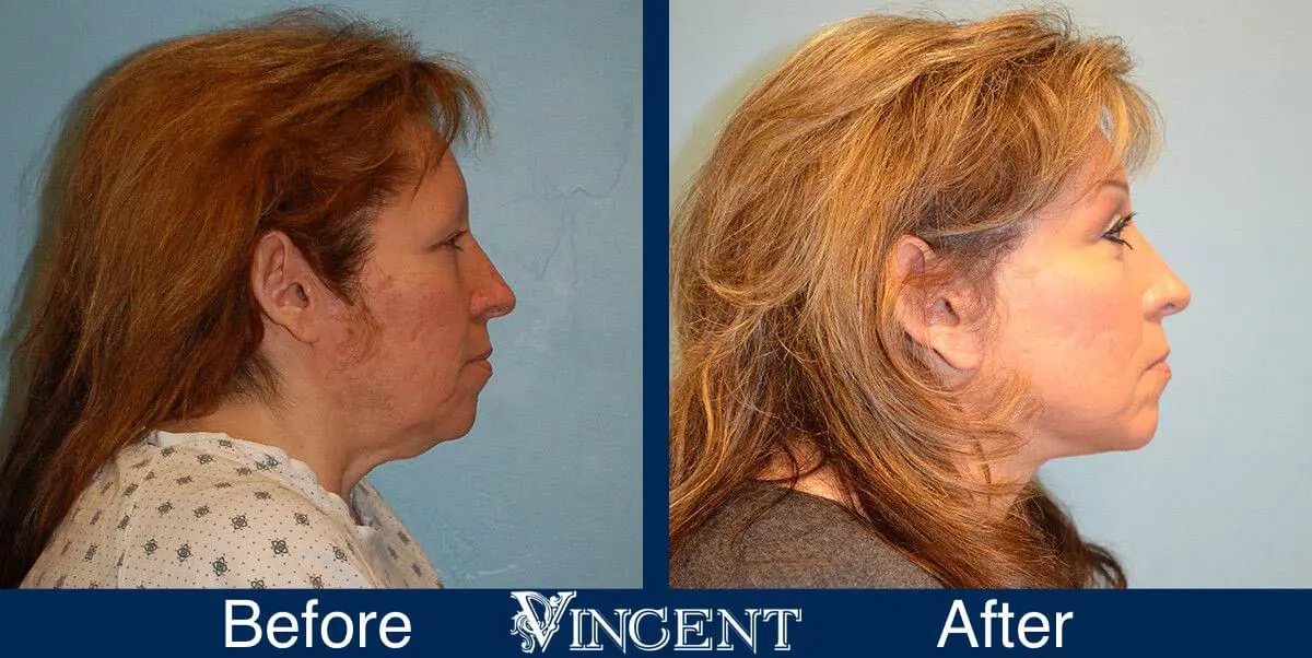 facelift-before-and-after-salt-lake-city-utah-1033_SwiftLift_upper_and_lower_blephs_Submental_lipo_chemical_peel_on_low