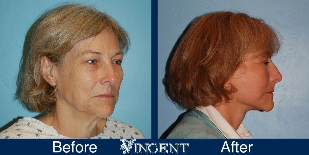 facelift-before-and-after-salt-lake-city-utah-1035_Swiftlift-5