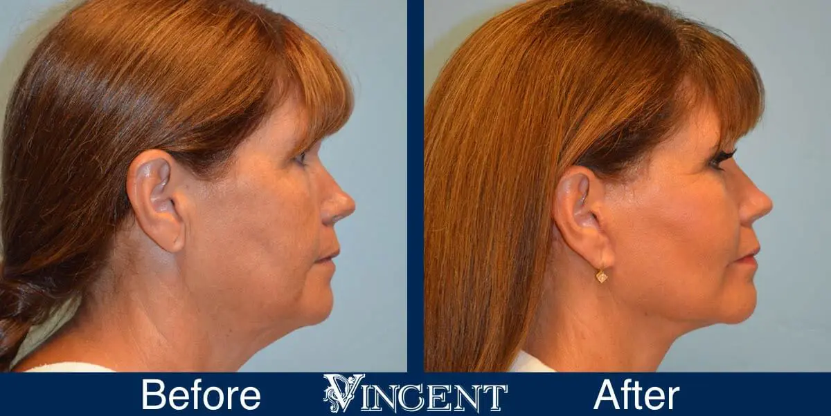 facelift-before-and-after-salt-lake-city-utah-1036_Swiftlift-7