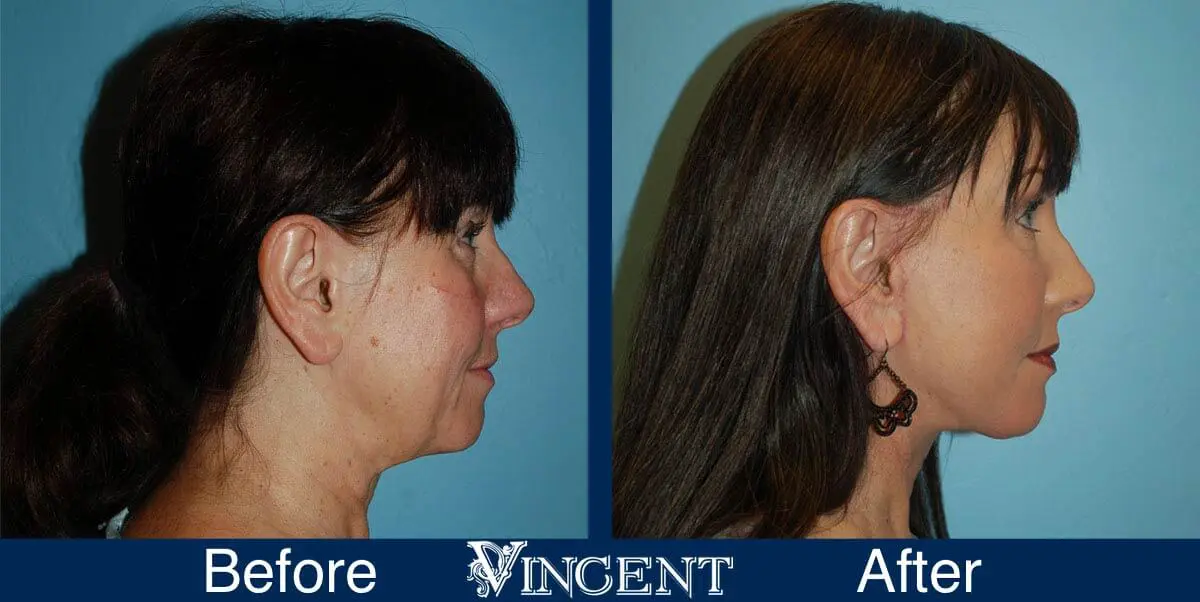 facelift-before-and-after-salt-lake-city-utah-1037_Swiftlift-10