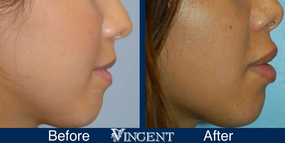 lip-augmentation-before-and-after-utah-vincent-surgical-arts-0901_lip_aug_side