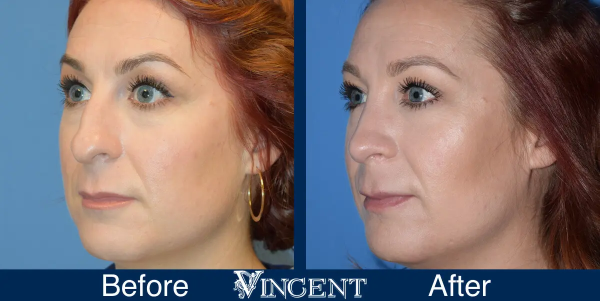 nose-job-before-and-after-female-salt-lake-city-utah-left-2