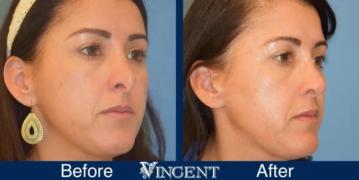nose-job-before-and-after-female-salt-lake-city-utah-right-2-1