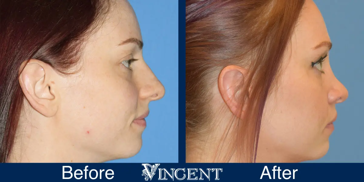 nose-job-before-and-after-female-salt-lake-city-utah-side-3-1