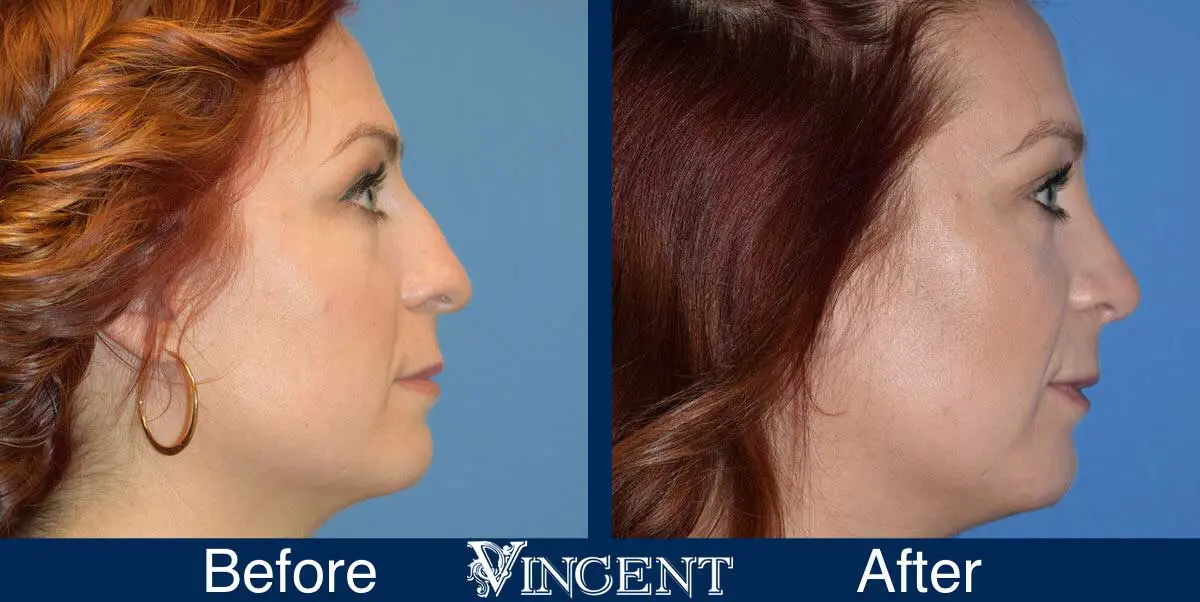 nose-job-before-and-after-female-salt-lake-city-utah-side-3-right