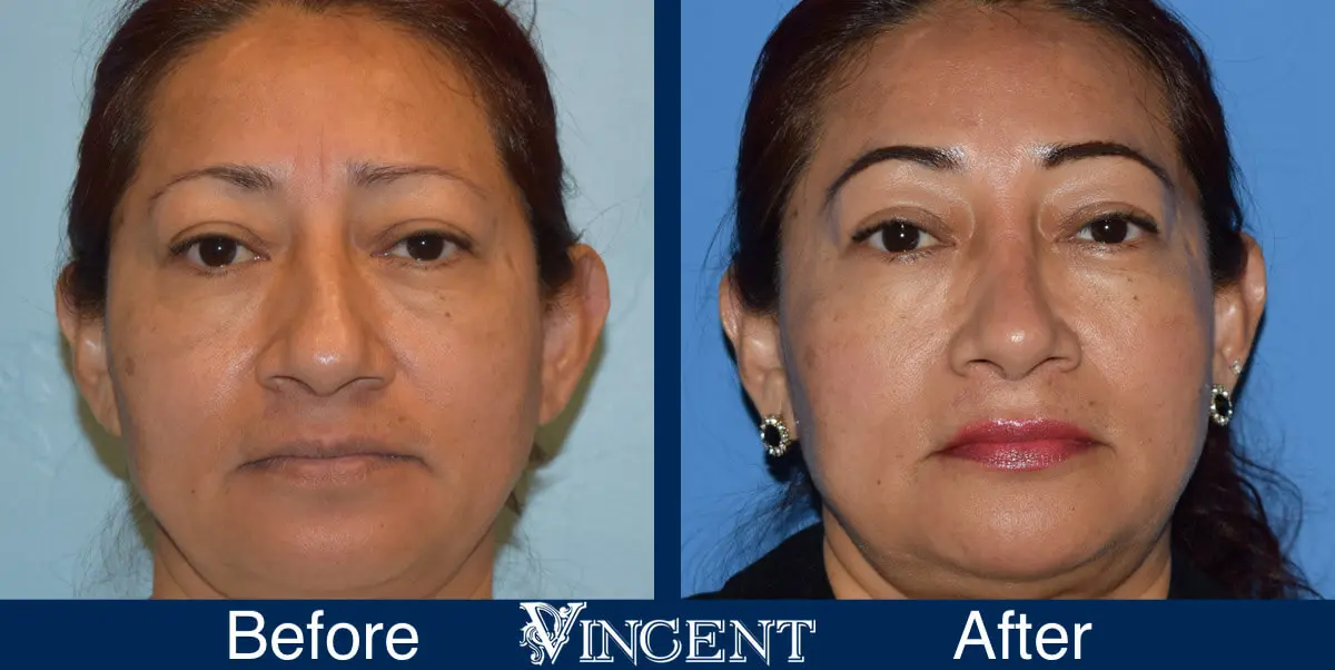 nose-job-before-and-after-female-utah-front-1-1