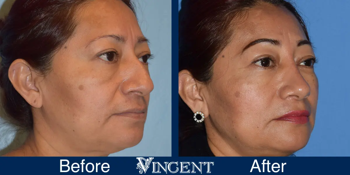 nose-job-before-and-after-female-utah-right-2-1