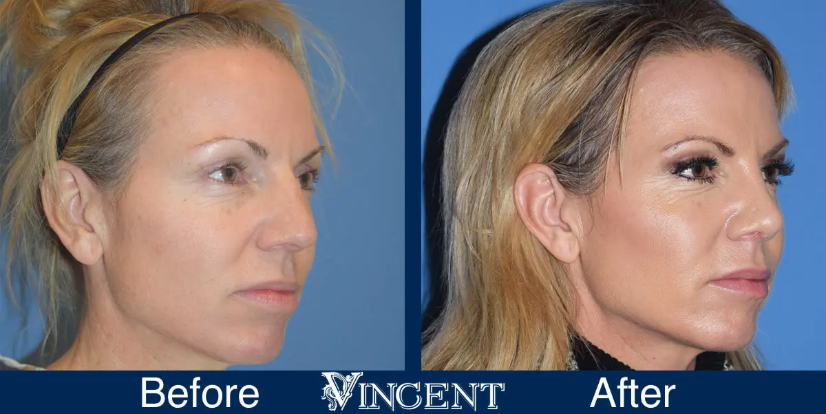 nose-job-before-and-after-female-utah-right-2-2