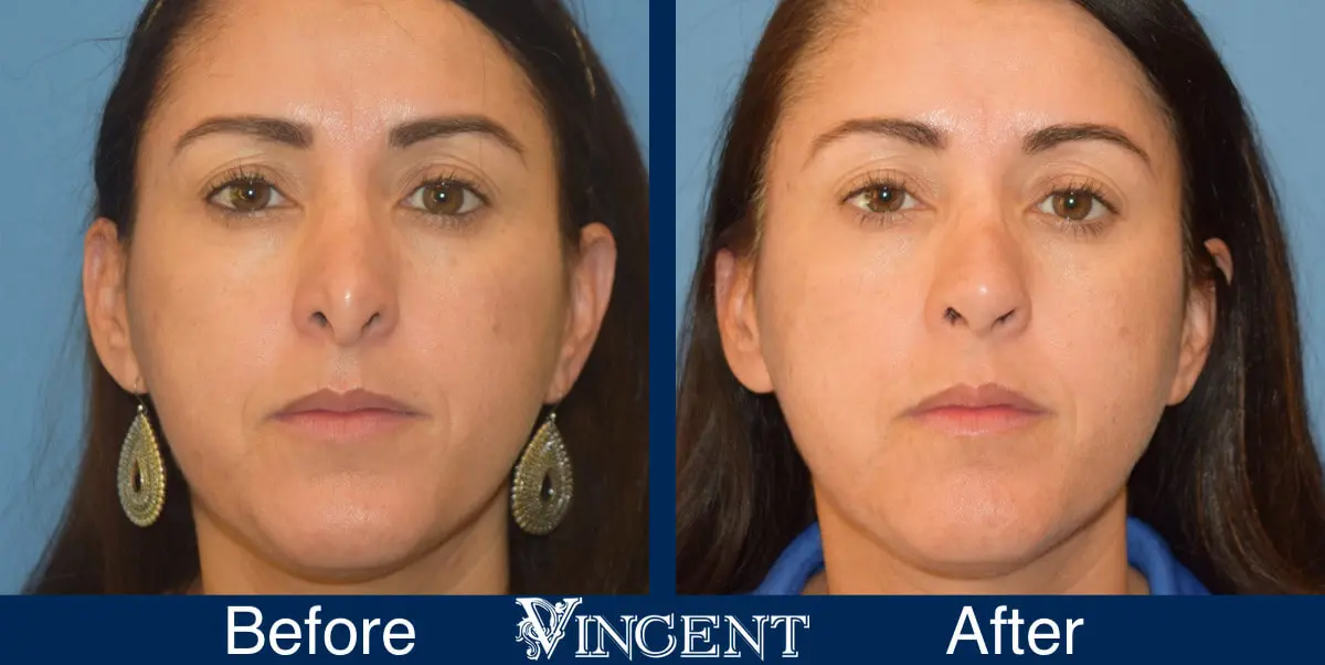 nose-job-before-and-after-female-utah-salt-lake-city-front-1-2