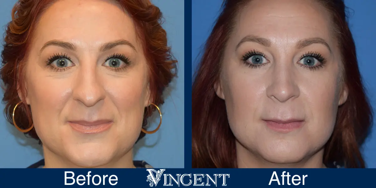 nose-job-before-and-after-female-utah-salt-lake-city-front-1