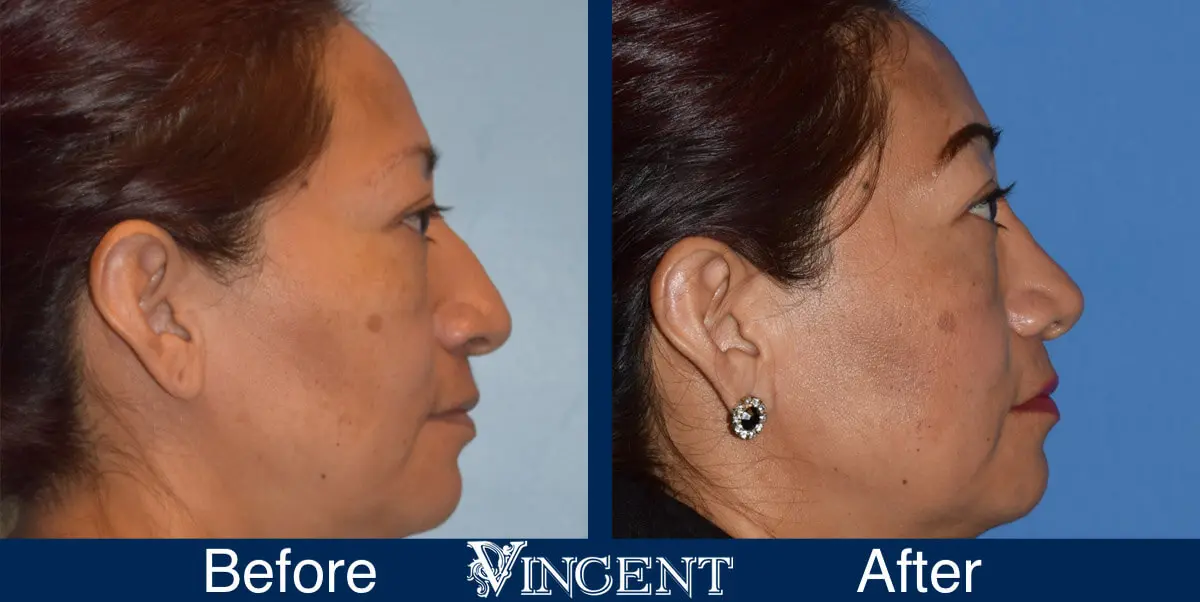 nose-job-before-and-after-female-utah-side-3-1