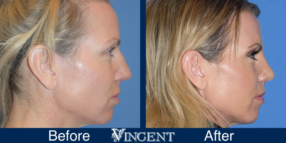 nose-job-before-and-after-female-utah-side-3-2