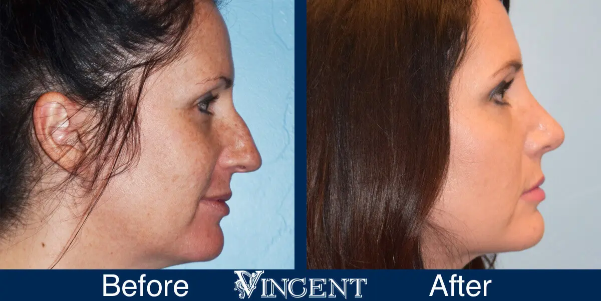 nose-job-before-and-after-female-utah-side-3