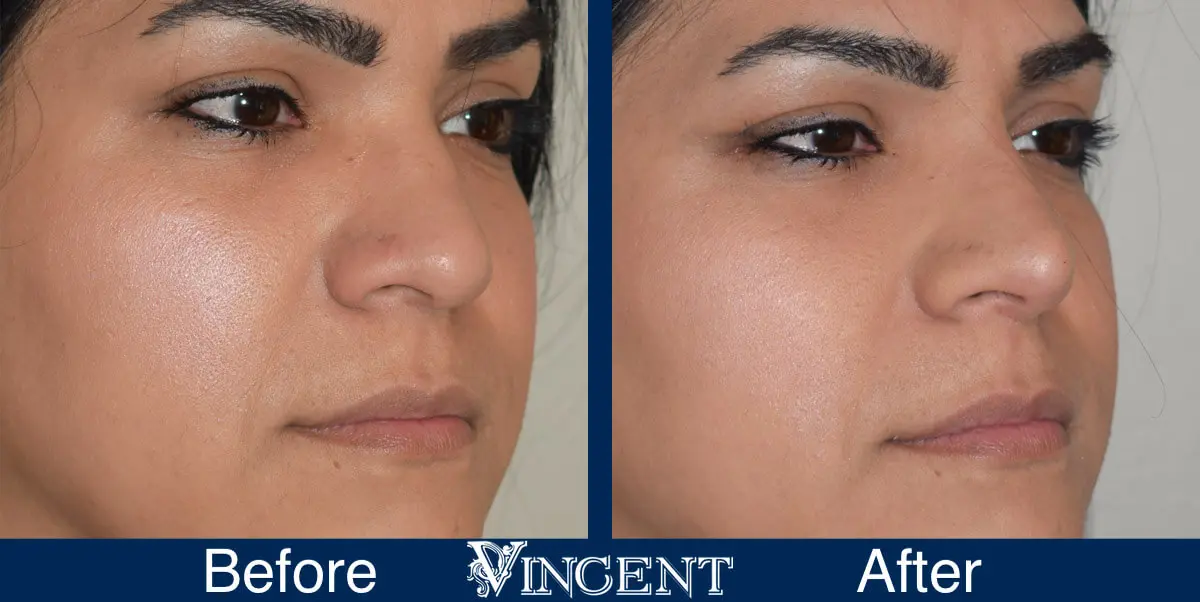 rhinoplasty-before-and-after-female-salt-lake-city-utah-right-2