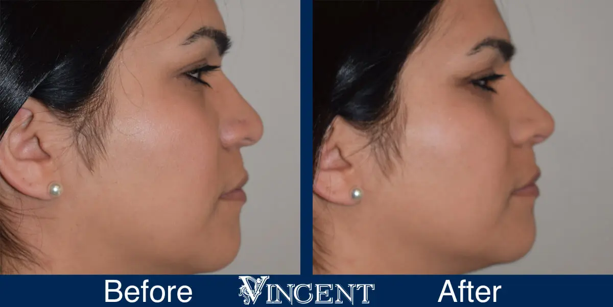 rhinoplasty-before-and-after-female-salt-lake-city-utah-side-3