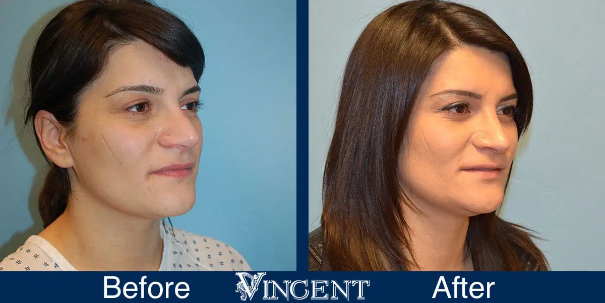 rhinoplasty-nose-job-salt-lake-city-utah-4501-front-right