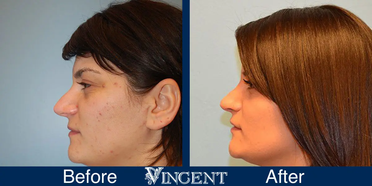 rhinoplasty-nose-job-salt-lake-city-utah-4501-left