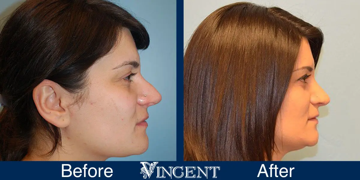 rhinoplasty-nose-job-salt-lake-city-utah-4501-right