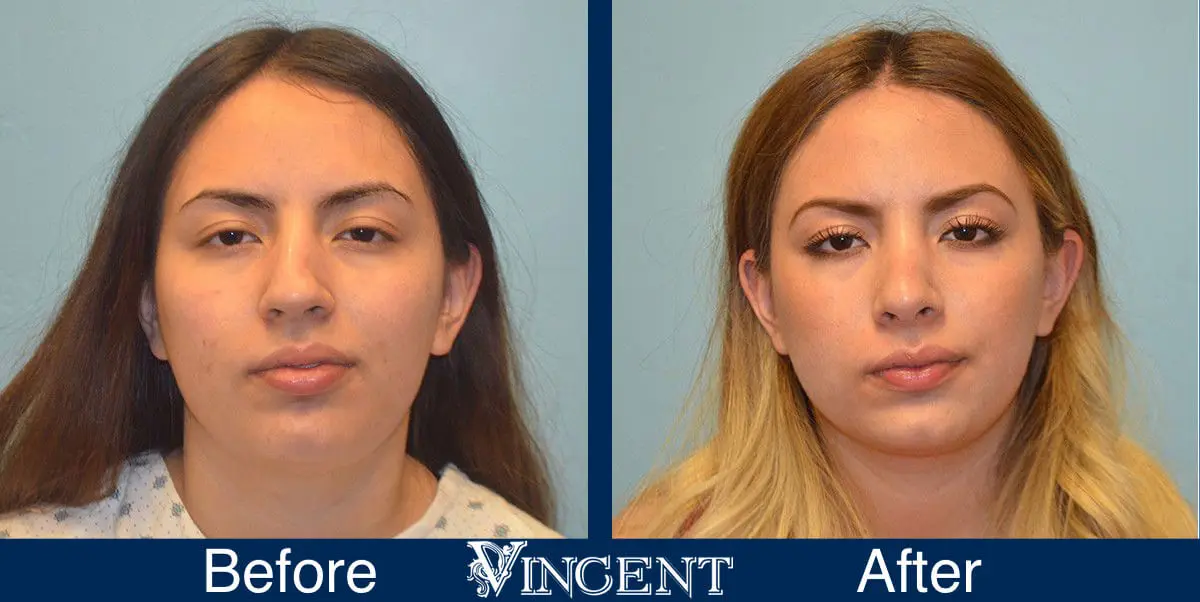 rhinoplasty-nose-job-salt-lake-city-utah-4502-1