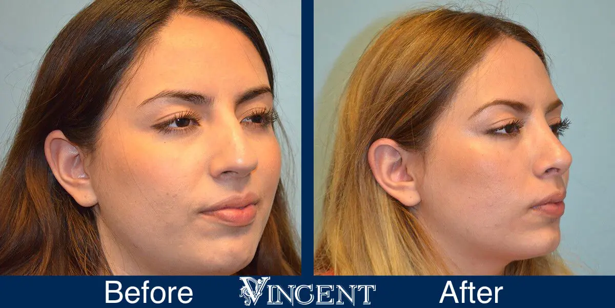 rhinoplasty-nose-job-salt-lake-city-utah-4502-2