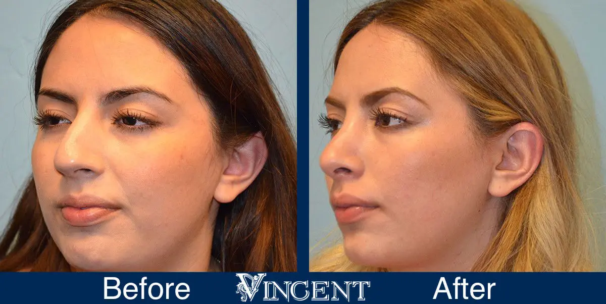 rhinoplasty-nose-job-salt-lake-city-utah-4502-4
