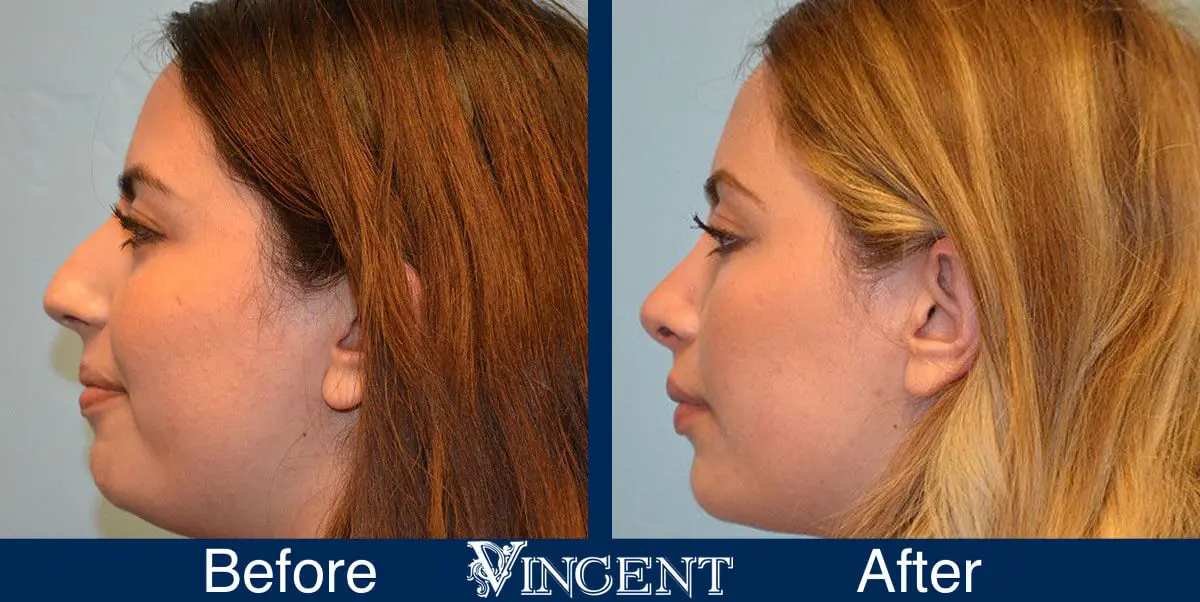 rhinoplasty-nose-job-salt-lake-city-utah-4502-5