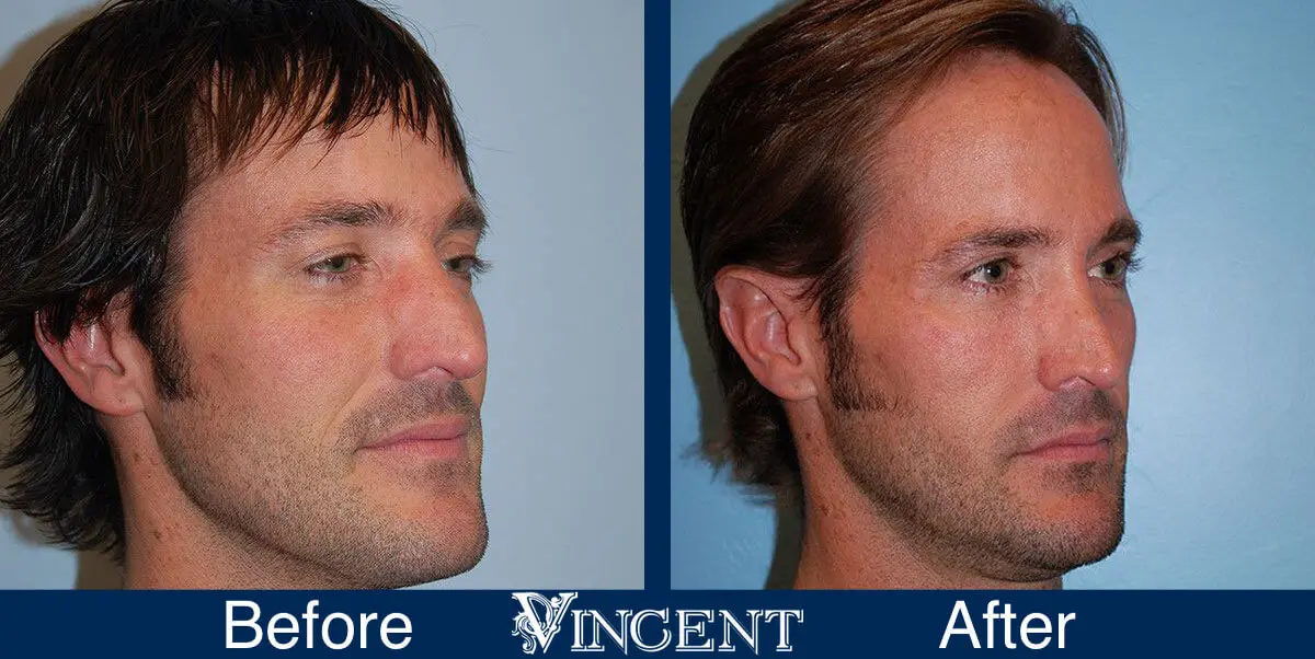 rhinoplasty-nose-job-salt-lake-city-utah-4503-front-right-1