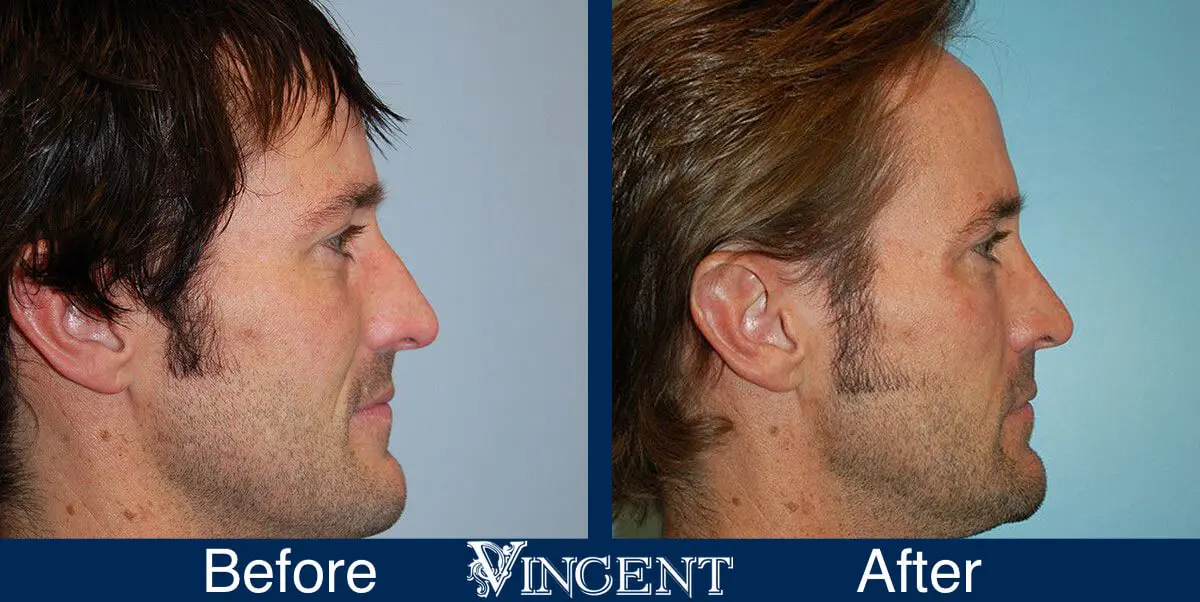 rhinoplasty-nose-job-salt-lake-city-utah-4503-right-1