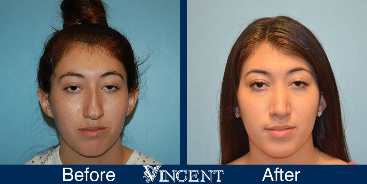 rhinoplasty-nose-job-salt-lake-city-utah-4505-1
