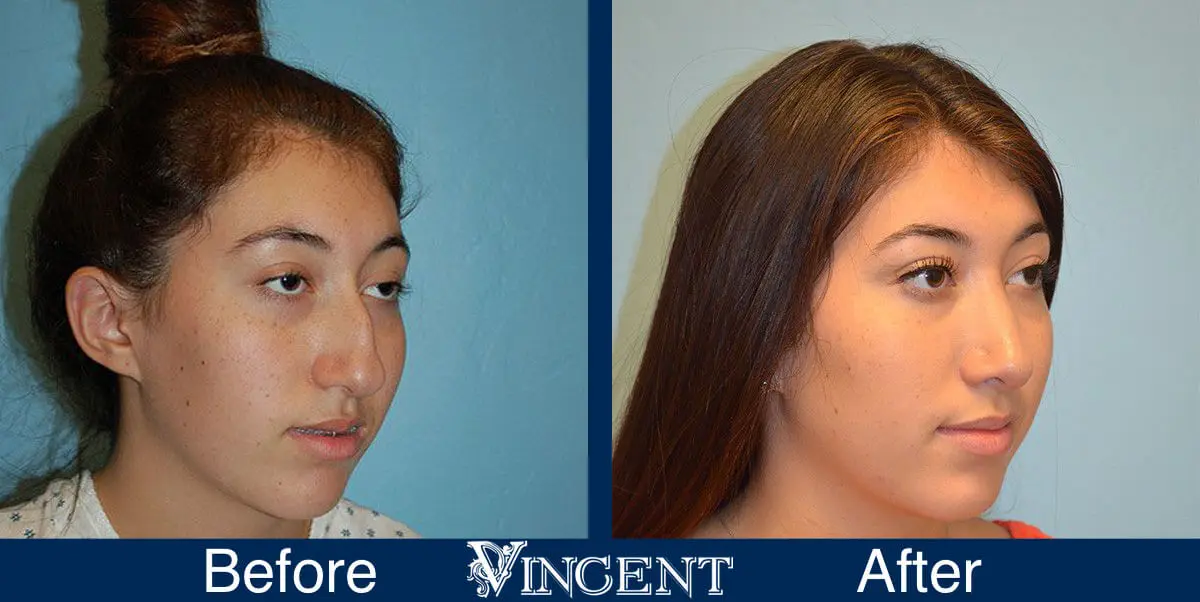 rhinoplasty-nose-job-salt-lake-city-utah-4505-2