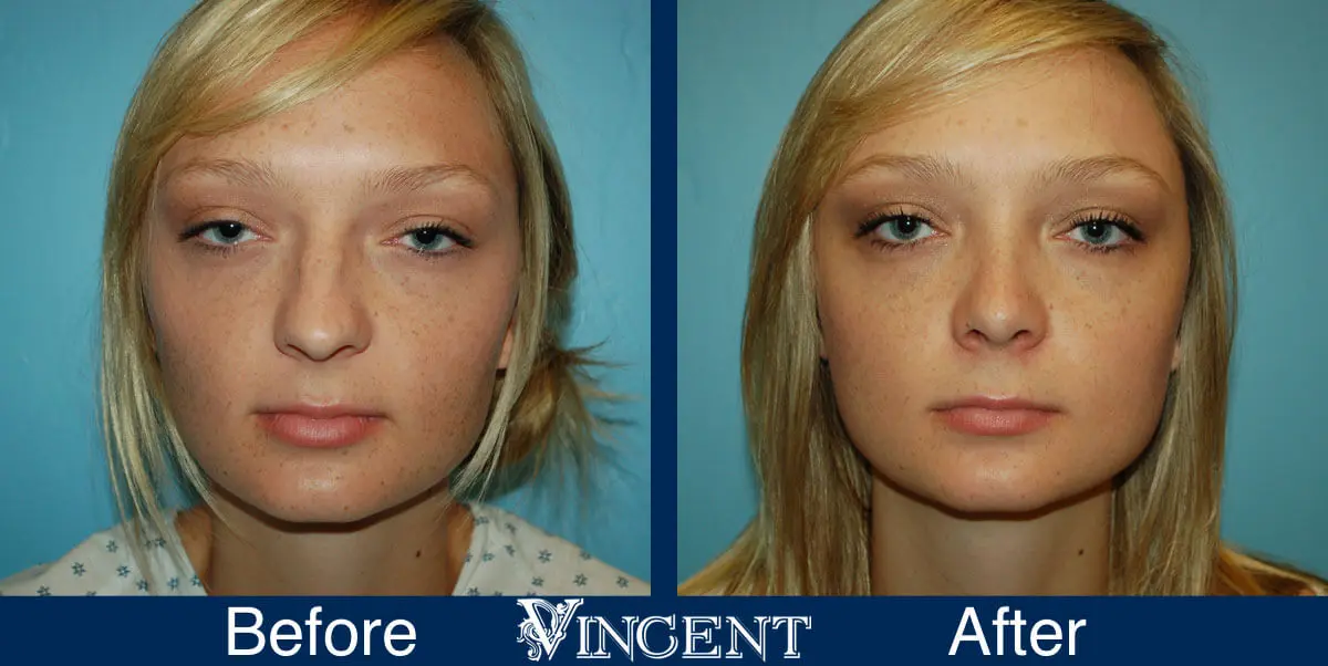 rhinoplasty-nose-job-salt-lake-city-utah-4513-1