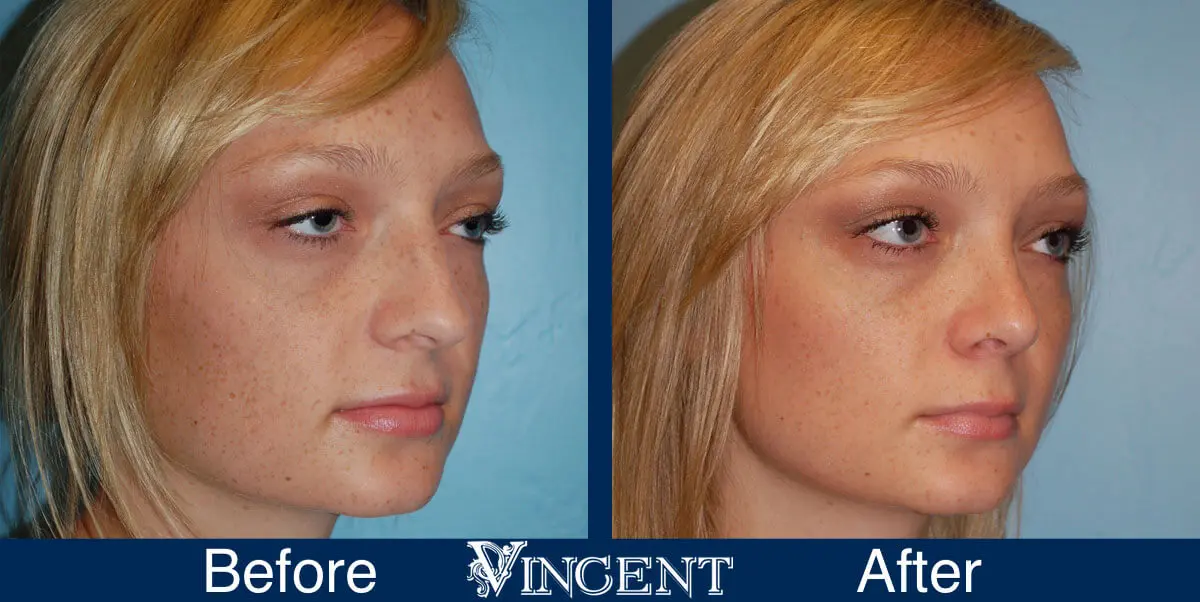rhinoplasty-nose-job-salt-lake-city-utah-4513-2