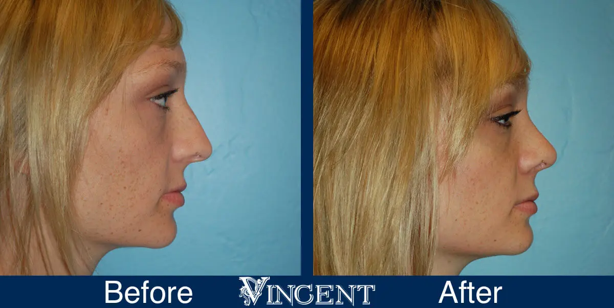 rhinoplasty-nose-job-salt-lake-city-utah-4513-3
