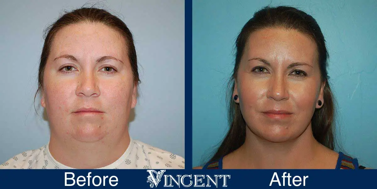 submental-liposuction-before-and-after-utah-vincent-surgical-arts-3001-facefront