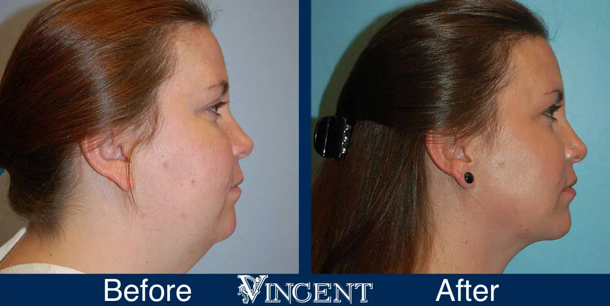 submental-liposuction-before-and-after-utah-vincent-surgical-arts-3001-rightside2