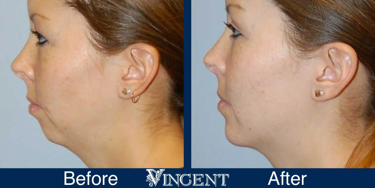 submental-liposuction-before-and-after-utah-vincent-surgical-arts-3002-left1