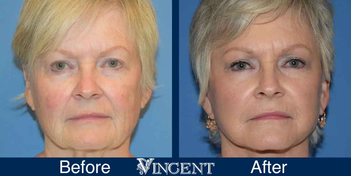 swift-lift-before-and-after-facelift-front-1