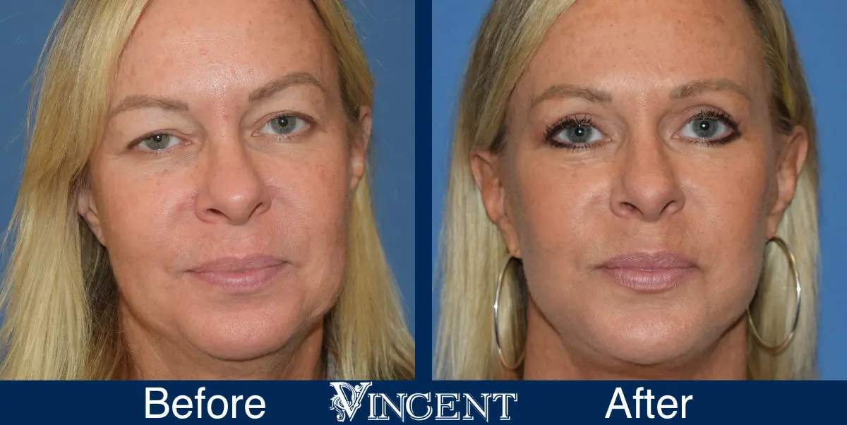 swift-lift-before-and-after-facelift-front-2