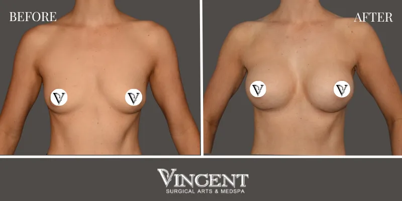 Breast 1-1