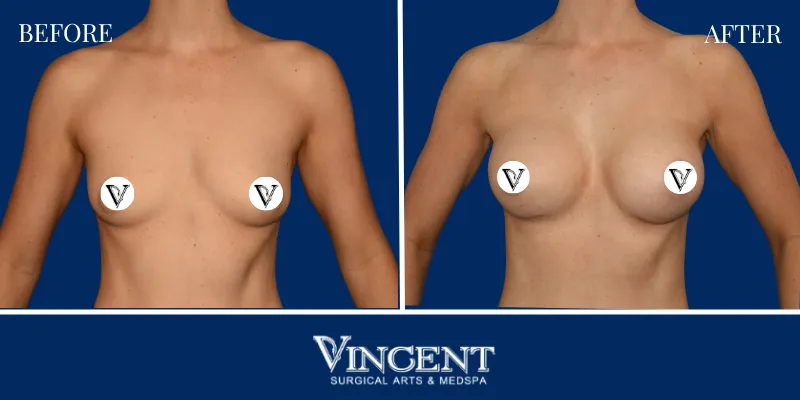 Breast 1-1