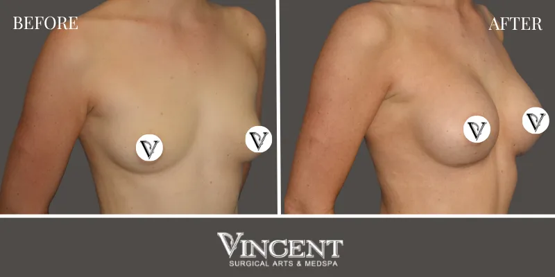 Breast 1-2