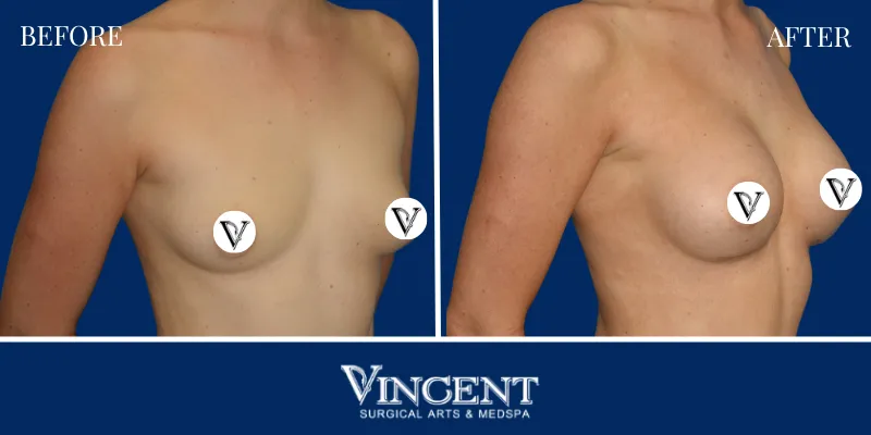 Breast 1-2